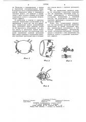 Способ образования подвижной основы для глазного протеза (патент 1197664)