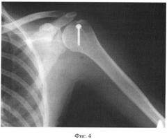 Способ оперативного лечения нестабильности плечевого сустава (патент 2412666)