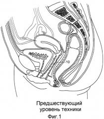 Коррекция стрессового недержания мочи (патент 2548825)