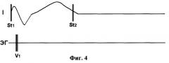 Способ оценки электрических свойств рабочего миокарда (патент 2261124)