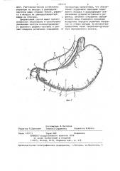 Способ хирургического лечения язвенной болезни двенадцатиперстной кишки (патент 1255112)