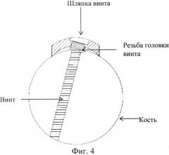 Способ защиты головок винтов от срыва при накостном остеосинтезе и устройство для его предупреждения (патент 2577764)