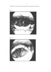 Способ лечения контактных гранулём гортани (патент 2591546)