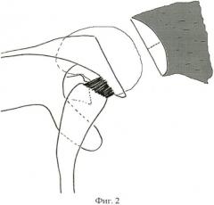Способ оперативного лечения застарелого заднего вывиха плеча (патент 2481798)