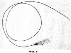 Эндоскопическая кюретка (варианты) (патент 2317791)