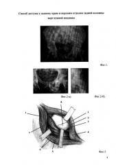 Способ доступа к заднему краю и верхним отделам задней колонны вертлужной впадины (патент 2585748)