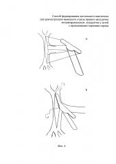 Способ формирования дистального анастомоза при реконструкции выводного отдела правого желудочка экстракардиальным кондуитом у детей с врожденными пороками сердца (патент 2644921)