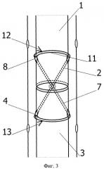 Способ наложения чрескожного погружного шва ахиллова сухожилия (патент 2398543)