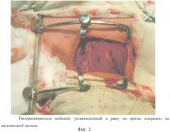 Ранорасширитель шейный (патент 2457798)