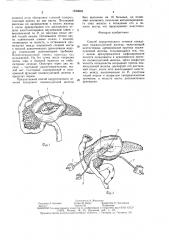 Способ хирургического лечения псевдокист поджелудочной железы (патент 1533663)
