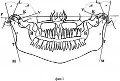 Метод определения инклинации мыщелкового отростка нижней челюсти на томограммах челюстей (патент 2633330)