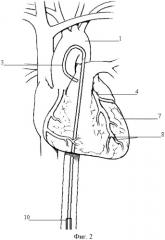 Коронарный катетер (патент 2355435)