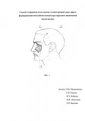 Способ устранения птоза мягких тканей средней зоны лица и формирования носогубной складки при параличе мимической мускулатуры (патент 2639811)