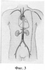 Способ хирургического лечения критической ишемии нижних конечностей у больных с тяжелой сопутствующей соматической патологией (патент 2390310)