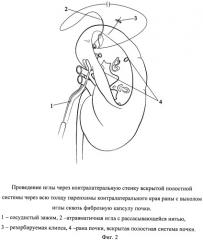 Способ одномоментного закрытия раны и полостной системы почки при лапароскопической резекции (патент 2532942)