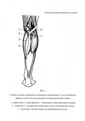 Способ установки имплантата голени (патент 2626267)