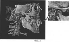 Способ нахождения оси головки нижней челюсти пациента (патент 2454180)