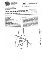 Устройство для остеосинтеза (патент 1678350)