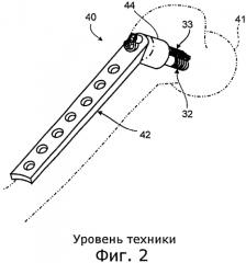 Регулирование компрессии кости (патент 2557692)