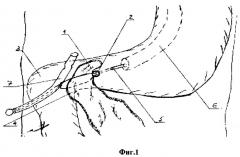 Способ эндоскопической оментопластики перфоративных гастродуоденальных язв (патент 2294170)