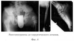 Способ ротационной остеопластики при проксимальных эктромелиях бедра (патент 2519381)
