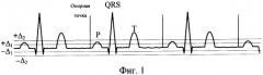 Способ выделения начала кардиоцикла в реальном времени и устройство для его осуществления (патент 2312593)