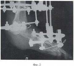 Способ реконструкции заднего отдела стопы после удаления остеомиелитически пораженной пяточной кости (патент 2381760)