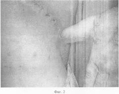 Способ кожной пластики при отрыве первого пальца кисти (патент 2336839)