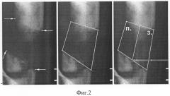 Способ оценки влияния разных методов нарушения целостности кости на процесс остеогенеза при дистракционном остеосинтезе (патент 2281032)