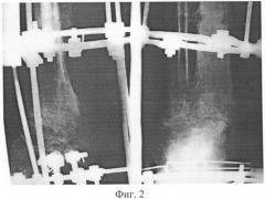 Способ артродеза при деструктивных поражениях голеностопного сустава (патент 2392892)