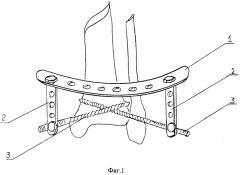 Способ чрескостной фиксации дистального метафиза большеберцовой кости (патент 2281712)