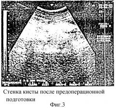 Способ предоперационной подготовки больного с острой постнекротической кистой поджелудочной железы к наложению панкреатоцистодигестивного анастомоза (патент 2294701)