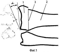 Способ устранения угловой деформации суставного отдела кости (патент 2325862)