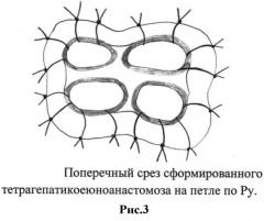 Способ формирования тетрагепатикоеюноанастомоза при высоких блоках желчевыводящих путей (патент 2506055)