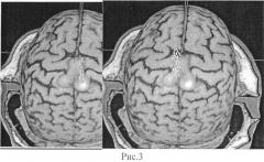 Способ выявления в коре головного мозга сенсомоторных зон, ответственных за локомоцию (патент 2504329)