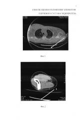 Способ оценки положения элементов плечевого сустава/эндопротеза (патент 2578858)