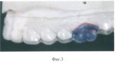 Способ оценки перемещений зубов в процессе лечения (патент 2498785)