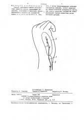 Способ свободной кожной аутопластики дефектов кисти (патент 1337059)