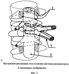 Способ переднего транспедикулярного спондилодеза (патент 2331378)