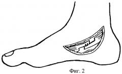Способ хирургического лечения молоткообразной деформации первого пальца стопы (патент 2285477)