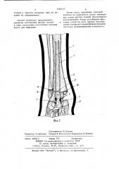 Способ лечения переломов лодыжек (патент 1189435)