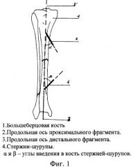 Способ чрескостного остеосинтеза костей голени (патент 2261675)