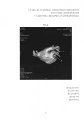 Способ окклюзии ушка левого предсердия во время коронарного шунтирования у пациентов с ишемической болезнью сердца (патент 2621954)