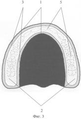 Полный съемный зубной протез верхней челюсти (патент 2314773)