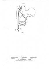 Устройство для компрессионного остеосинтеза (патент 1128937)