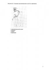 Способ формирования трахеопищеводной фистулы (патент 2634014)