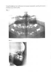 Способ профилактики зубочелюстно-лицевых аномалий у детей до 6 лет с полным отсутствием зубов (патент 2663631)