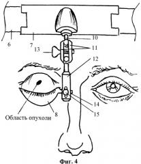 Установка для лечения опухолей кожи окологлазничной области (патент 2331446)