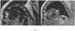 Способ оценки эффективности радиочастотной аблации почечных артерий у больных с резистентной артериальной гипертензией (патент 2554212)