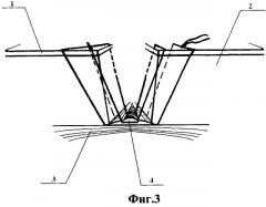 Комбинированный способ радикального хирургического лечения эпителиального копчикового хода (патент 2477085)